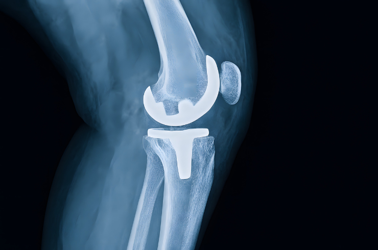 Total knee replacement